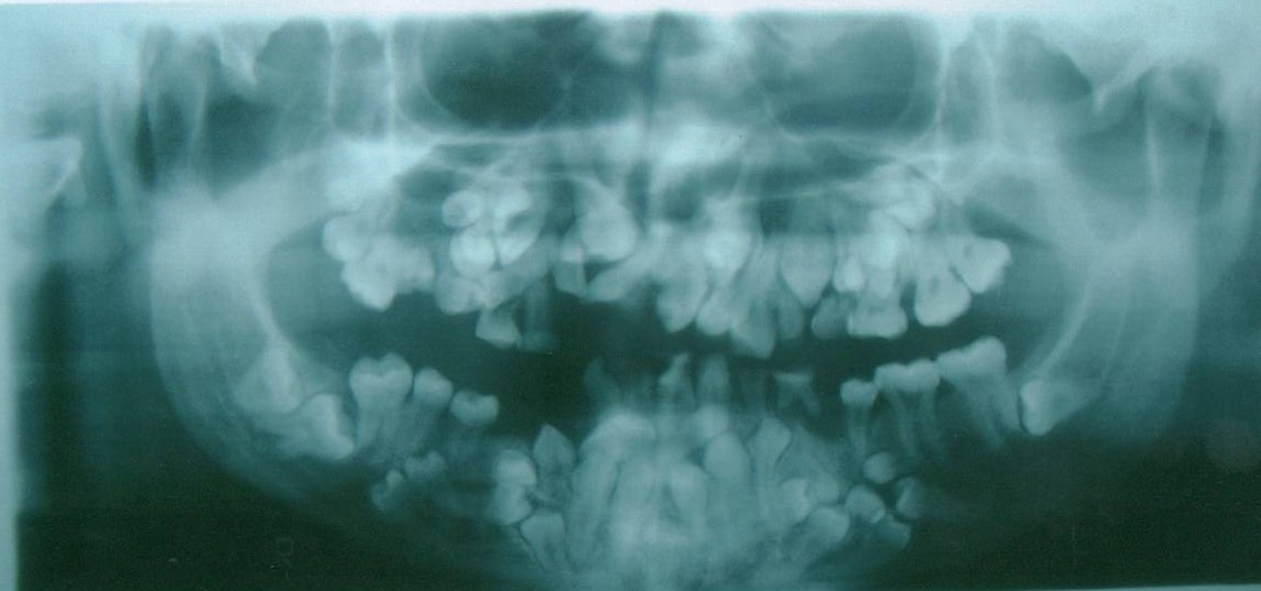 Cleidocranial_dysplasia_teeth.jpg