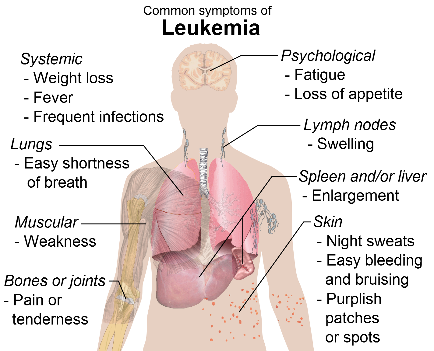Symptoms_of_leukemia.png
