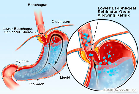 gastroesophageal-reflux.jpg
